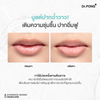 Dr.PONG hya-drop Volumizing Lip Serum: Before and After Results (shows visible improvement)