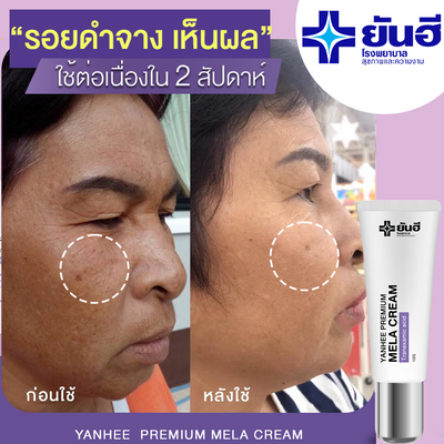 Amazing results with Yanhee Premium Mela Cream