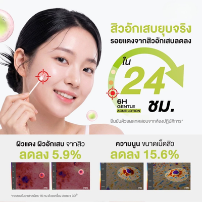 Acne care lotion for inflamed pimples