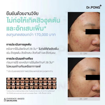 Dr.PONG Acne Ace Concealer with longwear film-forming technology