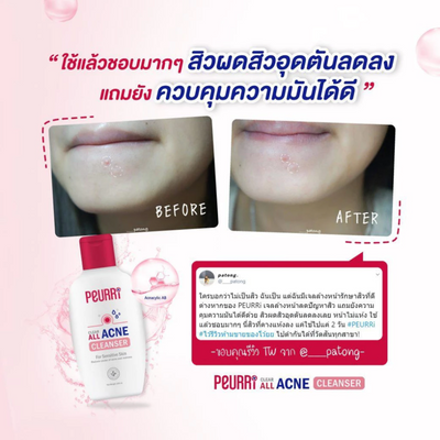 Non-drying acne gel with Vitamin B5