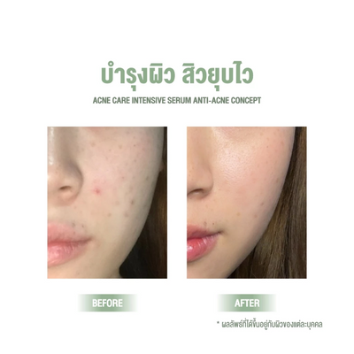 Quick-absorbing acne control serum