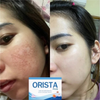 Freckle and dark spot removal supplement