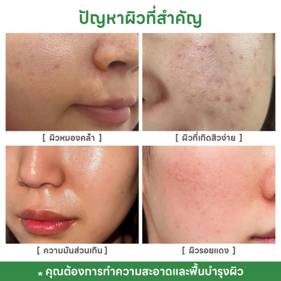 Tea tree oil and Centella Asiatica acne mask.