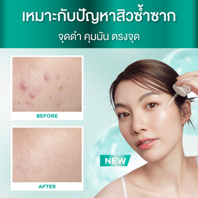 Before and after comparison of skin treatment with a woman using Smooth E PHA-AHA Acne Spot and Pore Smooth on a teal background.