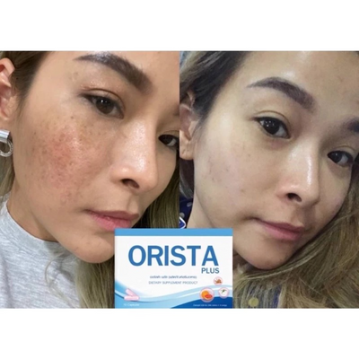 Orista Vitamin for dissolving freckles and dark spots