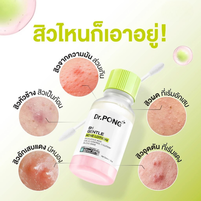 Acne calming and drying lotion