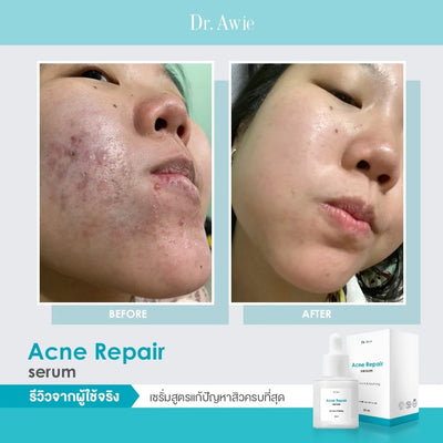 Reduce Scars and Oiliness with Dr. Awie Acne Serum