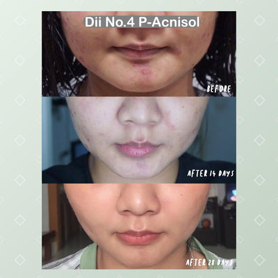 Acne prone skin dietary supplement