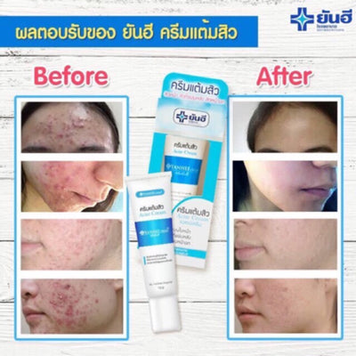 Acne cream for blemish-prone skin