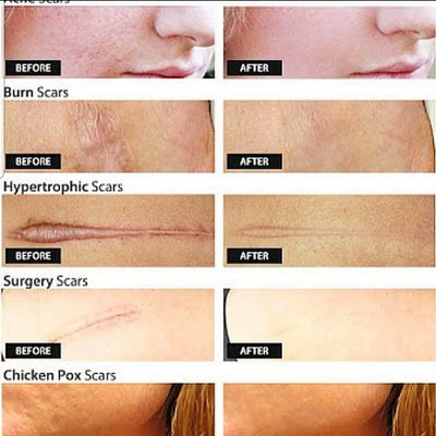 Non greasy scar reduction cream